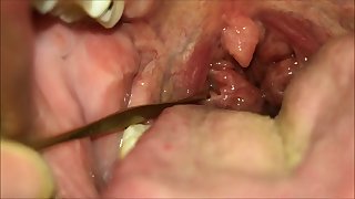 Extreme Tonsil Stone Removal Episode 22